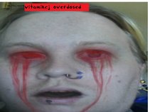 the vitamin cj overdosed