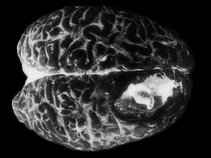 ACCUMULATOR syndrome