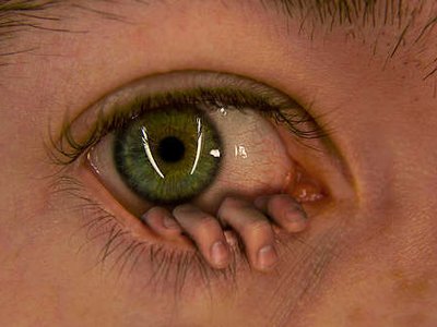 Epidimic photo