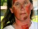 Emergency Preparedness Explosion Victim, August 2006