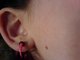 4mm right ear